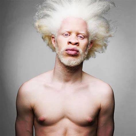 albino people naked